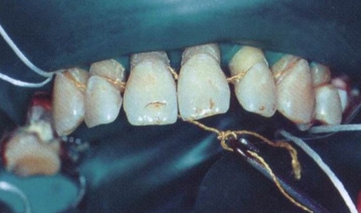 Часто пациенты в домашних условиях пытаются связать зубы ниточкой, чтобы они сошлись (здесь чаще всего речь идет о верхних центральных резцах