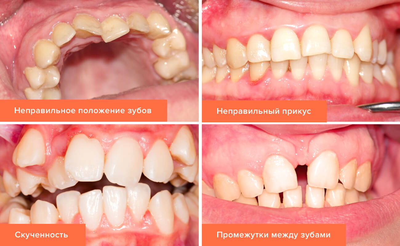 Фото видов неправильного прикуса